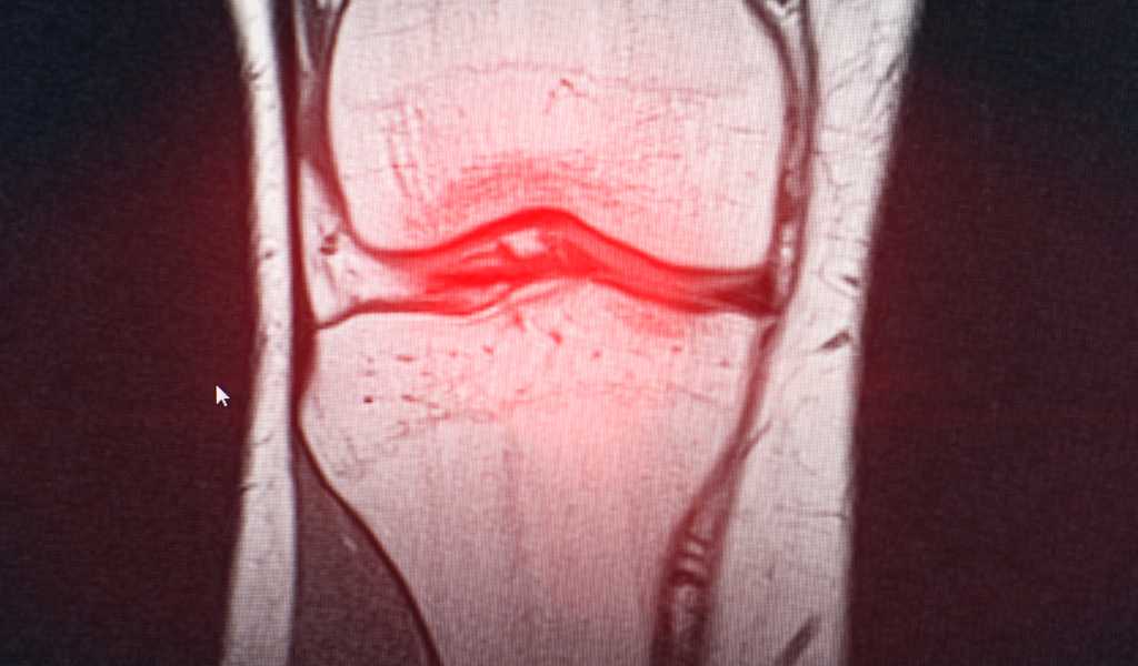 Chiropractic treatment for bursitis and tendonitis joint pain